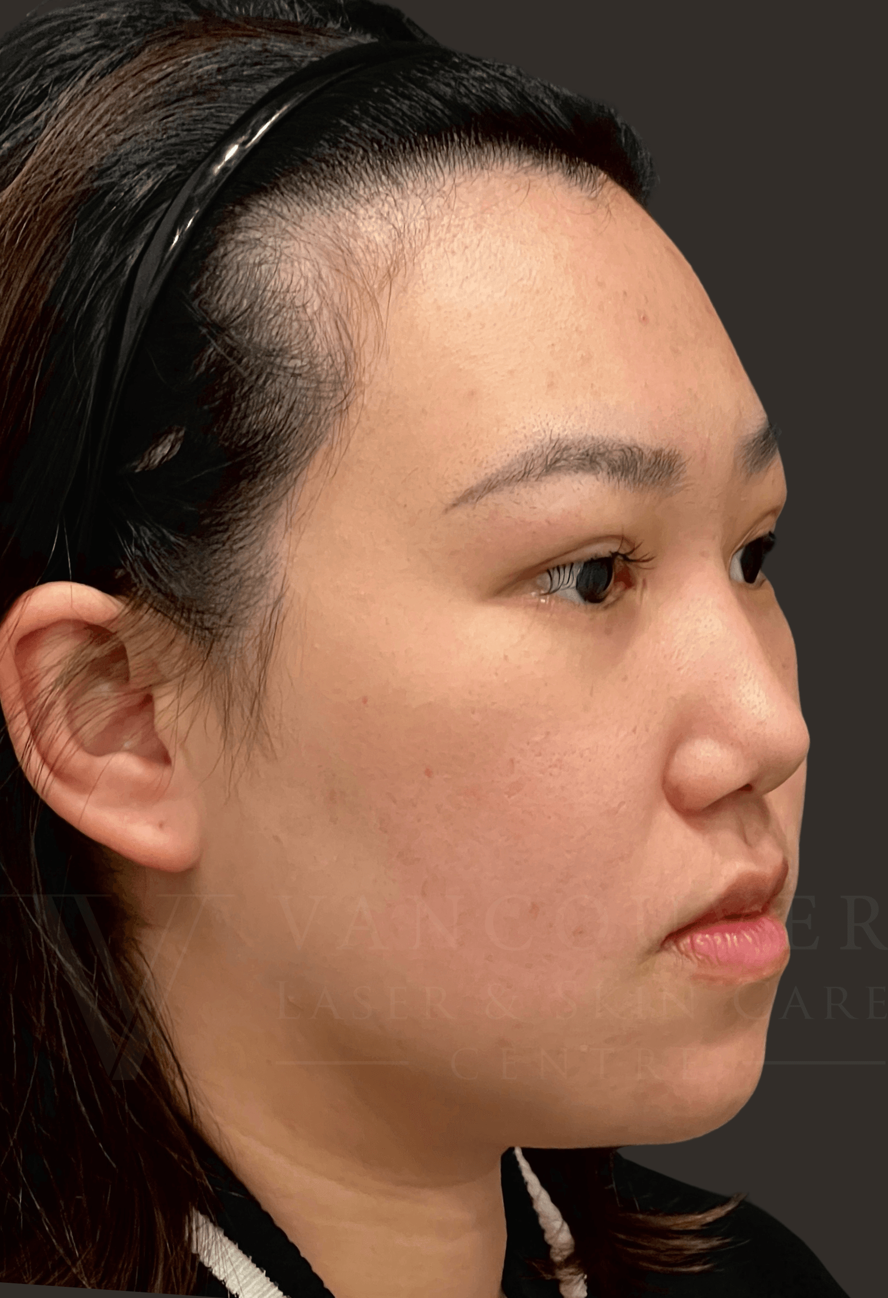 Photo from Vancouver Laser & Skin Care Centre's website