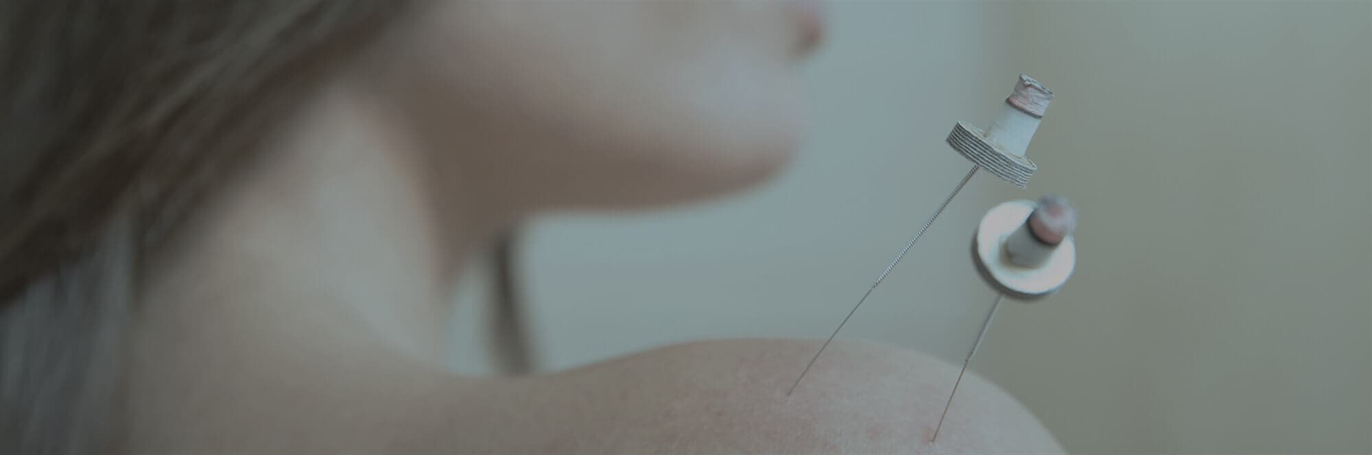 Acucure Acupuncture North Vancouver gallery image 3